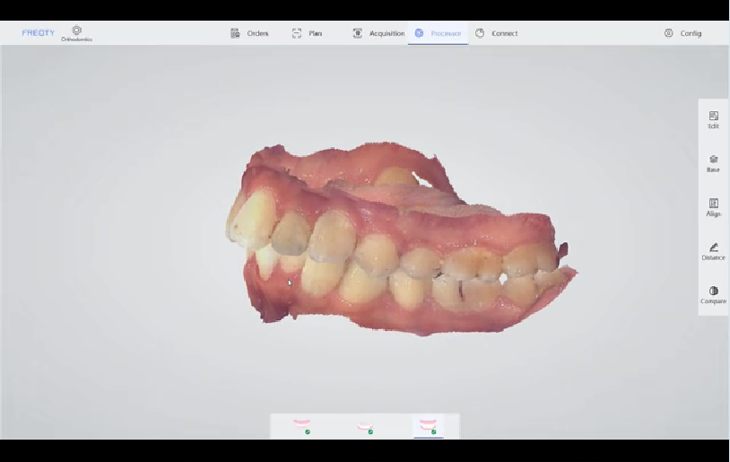 What is intraoral scanner？